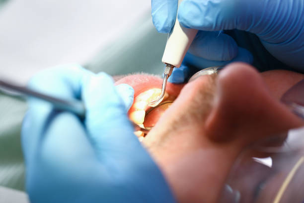 Best Dentist for Tooth Abscess  in Staples, CT