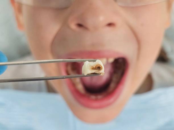 Best Broken Tooth Emergency  in Staples, CT